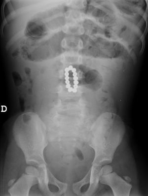 Radiografía simple de abdomen. Cuerpo extraño metálico en el intestino delgado con distensión de asas proximal y ausencia de aireación distal.