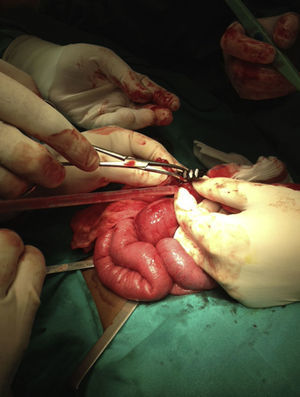 Extracción de imanes tras la enterotomía. Se visualiza una importante dilatación de asas de intestino delgado proximales y adhesión de 2 segmentos con el cuerpo extraño en su interior.