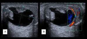 Ecografía de un teratoma quístico testicular (A) y su estudio Doppler (B). Imagen de tipo quístico de 24×14mm, con áreas en su entorno de tipo sólido (de tipo mamelonar) y una lengüeta en su porción inferior correspondiente con parénquima testicular sano (A).