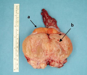 Pieza de orquidectomía: Parénquima testicular remanente (A) comprimido por una neoformación de contorno regular, blanquecina y con áreas gelatinosas (B).