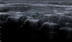 Ecografía de tiroides: a nivel posteroinferior del lóbulo tiroideo izquierdo se aprecia una lesión ovoidea, exofítica, parcialmente bien delimitada, micronodular, hipoecoica, con un tamaño aproximado de 16×4mm.
