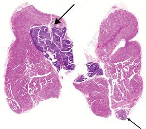 Biopsia de tiroides: prolongación tiroidea lateral izquierda: la imagen muestra en su seno un área incluida irregular no nodular de 10×7mm (flechas gruesas) correspondiente a parénquima tímico. Se observa además una glándula paratiroides adyacente (flecha fina).