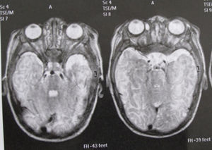 RM cerebral: atrofia lóbulo temporal derecho.