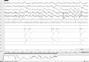 Vídeo-polisomnografía nocturna que muestra hipopneas obstructivas en sueño REM que se acompañan de desaturación de O2 (en el último canal) y arousal en el EEG. Abajo, el hipnograma donde se aprecia un sueño nocturno perturbado (descripción en el texto).