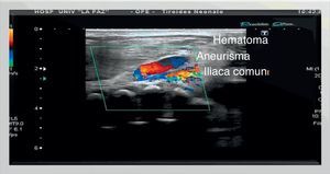 Saco aneurismático comunicado con la arteria iliaca común a través de un fino cuello con flujo turbulento en su interior en el doppler color, rodeado por hematoma hiperecogénico.