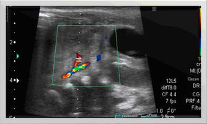 Imagen hiperecogénica indicativa de la trombosis del seudoaneurisma tras la inyección percutánea de trombina. El doppler color pone de manifiesto el flujo persistente a nivel de la arteria iliaca.