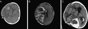 Imágenes de TC (A) y resonancia magnética (B y C) evolutivas. Progresión del hematoma parietal hacia lóbulo frontal que precisa craniectomía descompresiva (A y B). C) Estadio final con aumento del edema y por tanto de su efecto compresivo sobre el parénquima cerebral que protruye sobre la craniectomía. Hematomas intraparenquimatosos de nueva aparición en hemisferio cerebral derecho. Hematoma subdural y hemorragia intraventricular de nueva aparición. Hidrocefalia tetraventricular.