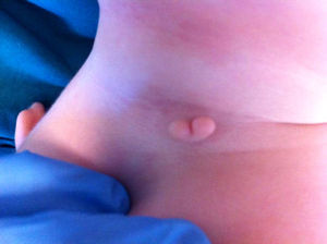 Fotografía de la lesión cervical. Fragmento bilobulado y pediculado en línea cervical media.