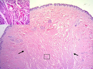 Lesión polipoidea con eje estromal con haces de músculo estriado. Se observan haces de músculo estriado perpendiculares a epidermis (flechas). Hematoxilina-eosina, x25.