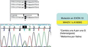 Mutación en el exón 10 del gen THRβ descrita en el paciente.