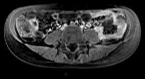 Corte axial T1 Fat-Sat postgadolinio: afectación ileal y yeyunal con hipercaptación mucosa severa.