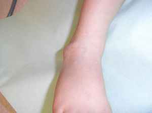Visión anteroposterior del pie derecho en el que se ve la tumoración en el maléolo externo.