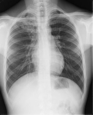 Radiografía de tórax que muestra infiltrado en el lóbulo superior derecho.