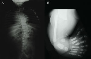 A) Radiografía AP de tórax con escoliosis dorso-lumbar, fusión costal (tercera con cuarta y quinta con sexta), así como 13 costillas en el hemitórax derecho, fusión costal (tercera con cuarta y novena con décima) sin costilla accesoria en el hemitórax izquierdo, falla múltiple hemivertebral de T4 a T7, T9 a T12 y en vértebras lumbares. B) Radiografía AP de la extremidad inferior izquierda con ausencia de la tibia y presencia de 8 dedos, con primer metatarsiano ausente e hipoplasia de las falanges del primer dedo, hipoplasia del tercer metatarsiano visible y ausencia de la falange terminal del cuarto dedo.