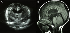 A) Corte coronal de la ecografía transfontanelar con dilatación del primer, segundo y tercer ventrículos. B) TC de cráneo (T1) con hidrocefalia obstructiva por estenosis congénita del acueducto de Silvio, fosa posterior y cuarto ventrículo pequeños, y herniación de las amígdalas cerebelosas (malformación Arnold-Chiari tipo 1).