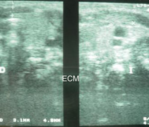 Hipoplasia del esternocleidomastoideo (ECM) derecho respecto al contralateral.