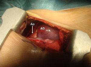 Campo quirúrgico a través de toracotomía axilar, mostrando la aurícula derecha (AD) en el centro y la aorta (Ao) a su izquierda.