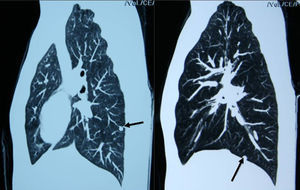 Imágenes de metástasis pulmonares de un feocromocitoma (flechas). Obsérvese su distribución periférica «en suelta de globos».