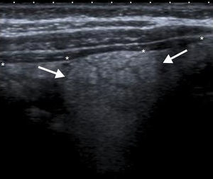 Aumento focal de la ecogenicidad de la grasa intraabdominal (flechas), situada en profundidad con respecto al peritoneo parietal (*), en el vacío derecho, con áreas lineales hipoecoicas, en relación con cambios inflamatorios a este nivel.