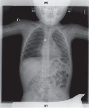 Radiografía de tórax donde se visualiza la presencia de una pila de botón en el bronquio principal derecho.