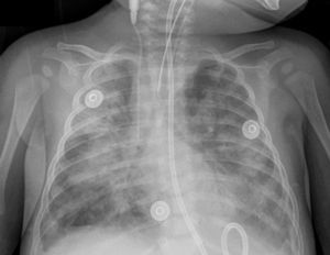 Radiografía de tórax anteroposterior con infiltrados intersticiales bilaterales.