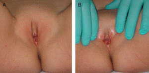Clitoromegalia en la niña. A) Detalle de la clitoromegalia con capuchón alargado. B) Clitoromegalia y detalle del introito.