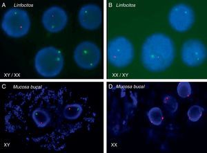 Técnica de FISH en núcleos en interfase de linfocitos de sangre periférica (A en niño y B en niña). La sonda del cromosoma X está marcada en verde y la del Y en rojo. Nótese que en ambos se aprecian células con puntos rojos y verdes (XY) y células con dos puntos verdes (XX). En la parte inferior, se emplea la misma técnica, pero en células de mucosa bucal; sin embargo, en este caso está cambiado el color de las sondas (rojo el X y verde el Y). El 100% de las células en el varón son XY (C), mientras que el 100% de las células en la niña son XX (D).
