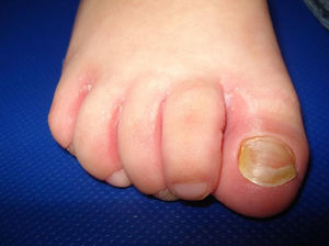 Distrofia ungueal del primer dedo del pie derecho y leves lesiones intertriginosas interdigitales.