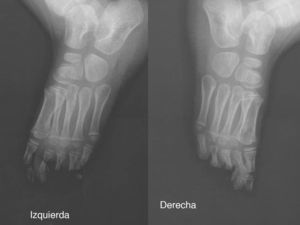 Radiografía simple oblicua de los pies izquierdo y derecho: ausencia de las falanges distales del 3.er y 4.° dedos del pie izquierdo, ausencia de las falanges distales del 3.er, 4.° y 5.° dedos del pie derecho, y reabsorción del extermo distal de la falange proximal del resto de los dedos de los pies en ambos pies.