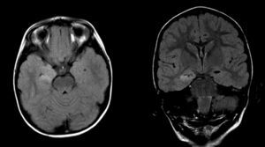 RMN de cráneo (sagital T2, axial Flair): aumento de la intensidad de señal en T2 en el hipocampo derecho.
