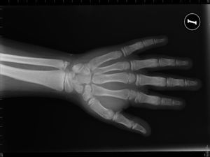 Radiografía de la mano izquierda del caso 1, que muestra braquimetacarpia, osteoporosis generalizada y edad ósea acelerada.