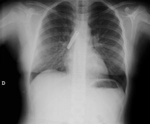 Radiografía de tórax donde se observa el cuerpo extraño (hoja de cortaúñas) alojado en el bronquio principal derecho de la paciente.