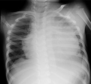 Radiografía de tórax: cardiomegalia con índice cardiotorácico de 0,73.