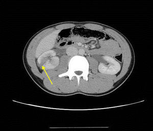 Corte axial de tomografía computarizada sin contraste en el que se observa la laceración del parénquima renal a través de la corteza y médula renal (flecha).