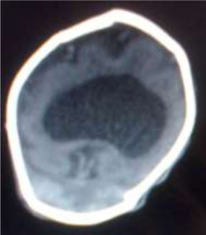 TC craneal de la paciente; ventrículo único compatible con holoprosencefalia alobar.