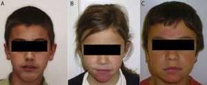 Fotos faciales con dermatitis de contacto en tres pacientes. A) Lesión color blanca en mentón. B) Lesión rojiza en mentón. C) Lesión rojiza en mentón y frente.