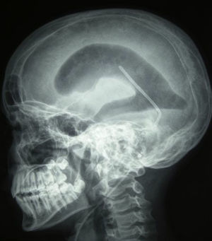 Radiografía lateral de cráneo: neumoventrículo correspondiente a los ventrículos laterales y válvula de derivación ventrículo-peritoneal.