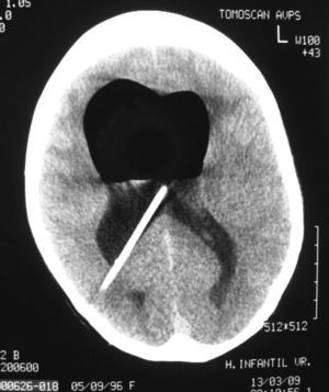 Tomografía computarizada craneal: imagen hipodensa correspondiente a neumoventrículo de los ventrículos laterales. Se observa también válvula de derivación ventrículo-peritoneal.
