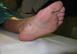 Placas de pequeño tamaño y pápulas eritematosas en la planta del pie izquierdo.