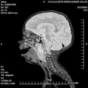 RM cerebral corte sagital: masa sólida (5,4x4,6x6 cm) desde naso a hipofaringe, con extensión por espacio retro -parafaríngeo derecho y hacia fosa posterior.