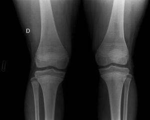 Radiografía anteroposterior de ambas rodillas. Se observan líneas osteocondensantes paralelas a la fisis («líneas cebra»).