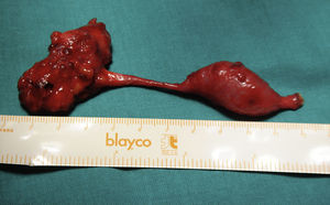 Pieza macroscópica de nefroureterectomía por valva ureteral distal y atresia ureteral proximal.