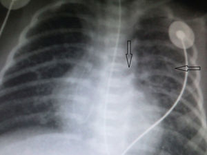 Radiografía de tórax. Imagen quística incipiente y punta de catéter (flechas).