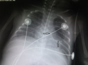 Radiografía de tórax. Imagen quística redondeada en progresión. Catéter retirado.