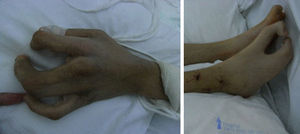 Ectrodactilia en ambas manos y pies.