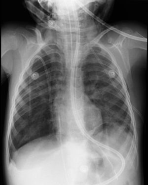 Radiografía de tórax en la que se observa gran fragmento de catéter pleural roto en el hemitórax derecho.