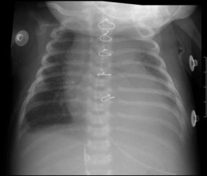 Radiografía de tórax en la que se observa una pequeña porción de catéter de drenaje pleural fracturado dentro de hemitórax derecho y porción no fracturada sobre la parrilla costal derecha.