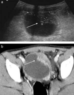 La ecografía (a) y la tomografía axial computarizada (b) mostraron un engrosamiento marcado de la pared vesical simulando carcinoma invasivo de vejiga.