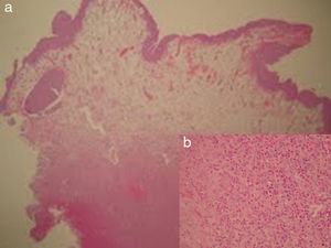 a) Pared de la vejiga, 4×. b) Aspecto microscópico de la pared de la vejiga con infiltración masiva de eosinófilos en la muscular.