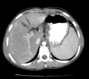 TC abdominal: parénquima con densidad heterogénea, áreas nodulares mal definidas y una atrofia relativa del segmento iv del lóbulo hepático izquierdo.